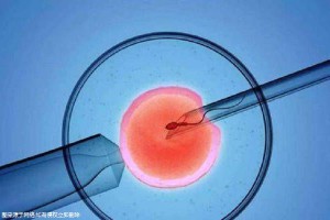 体外受精 IVF-ET